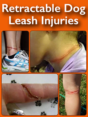 Retractable Dog Leash Injuries are serious but can be avoided with a Better Dog Leash